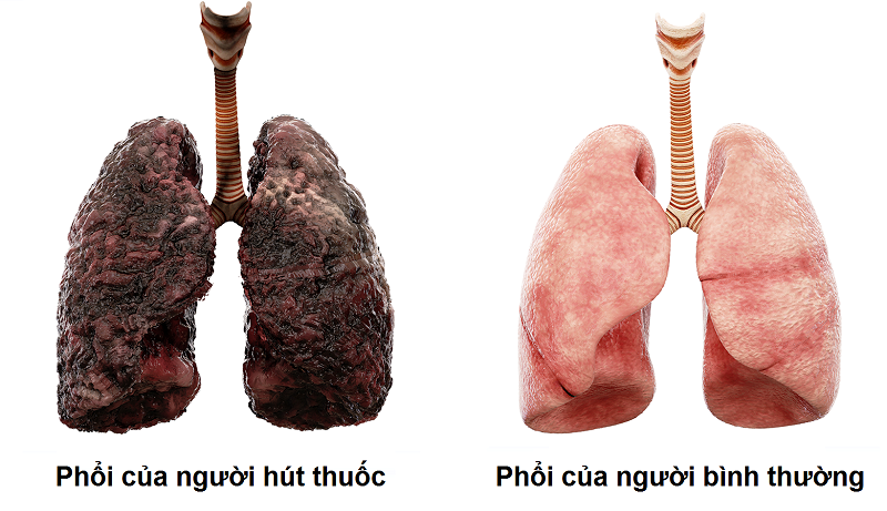 Hút thuốc lá là kẻ thù của lá phổi 